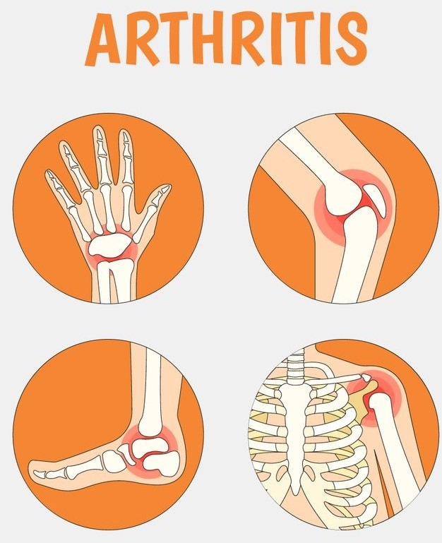 Arthritis